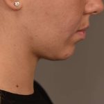 Buccal Fat Removal Before & After Patient #2085
