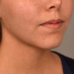 Buccal Fat Removal Before & After Patient #2092