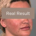 Buccal Fat Removal Before & After Patient #2108