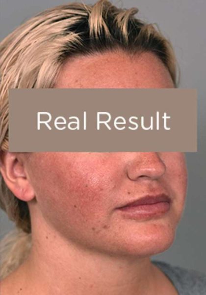 Buccal Fat Removal Before & After Patient #2108