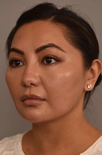 Cheek Liposuction Before & After Patient #2136