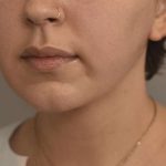Cheek Liposuction Before & After Patient #2139
