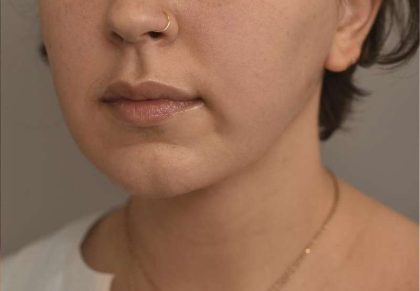Cheek Liposuction Before & After Patient #2139