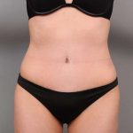 Tummy Tuck Before & After Patient #418