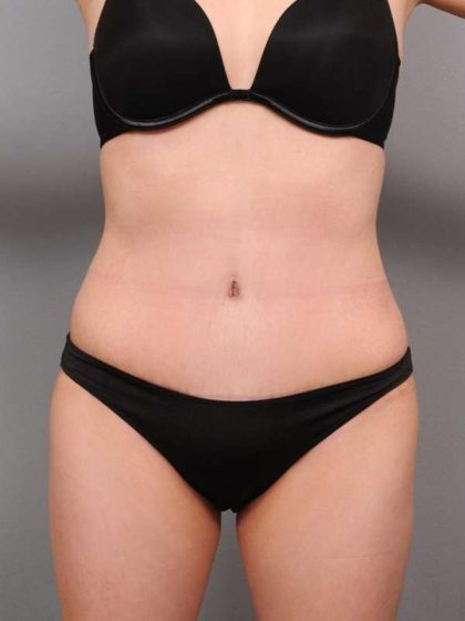 Tummy Tuck Before & After Patient #418