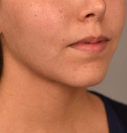 Cheek Liposuction Before & After Patient #2149