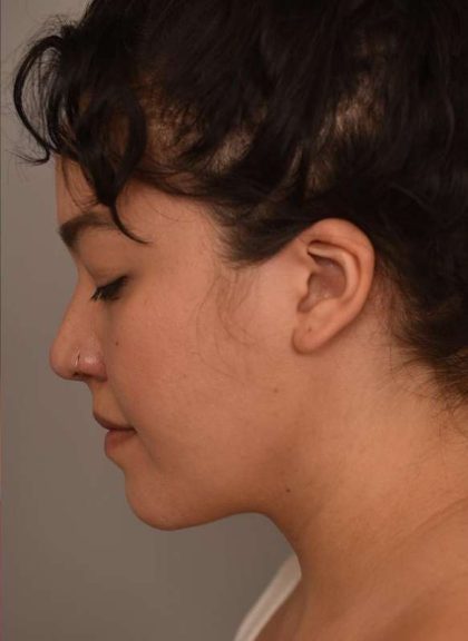 Cheek Liposuction Before & After Patient #2154