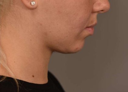 Cheek Liposuction Before & After Patient #2170