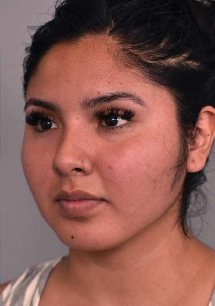 Cheek Liposuction Before & After Patient #2186