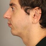 Chin Implant Before & After Patient #2203
