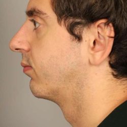 Chin Implant Before & After Patient #2203