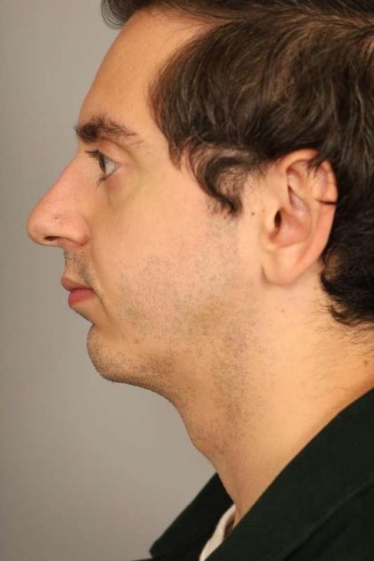 Chin Implant Before & After Patient #2203
