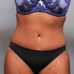 Tummy Tuck Before & After Patient #427