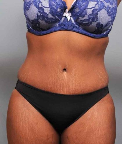 Tummy Tuck Before & After Patient #427