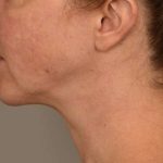 Chin Implant Before & After Patient #2220