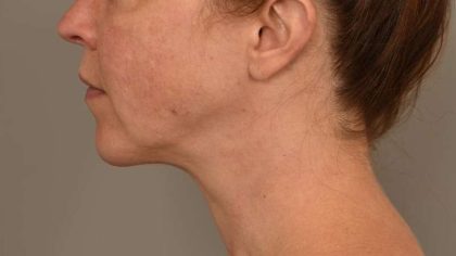 Chin Implant Before & After Patient #2220