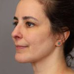 Chin Implant Before & After Patient #2227