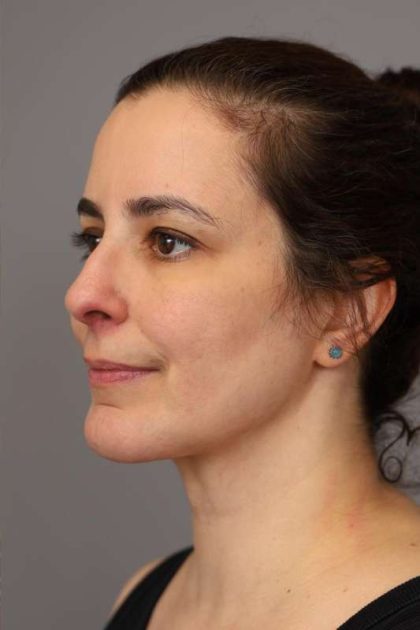 Chin Implant Before & After Patient #2227