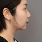 Chin Implant Before & After Patient #2234