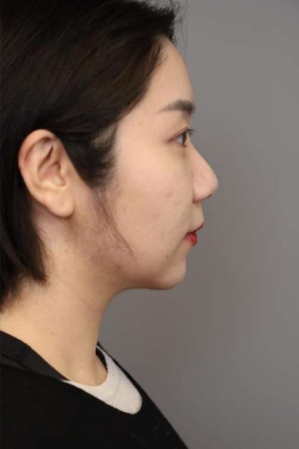 Chin Implant Before & After Patient #2234