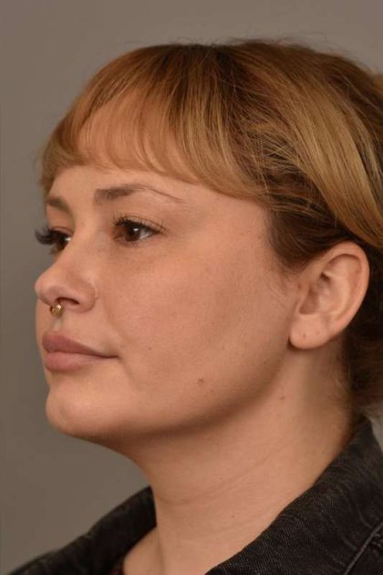 Chin Implant Before & After Patient #2246