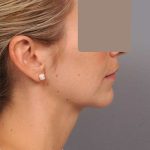 Chin Implant Before & After Patient #2253