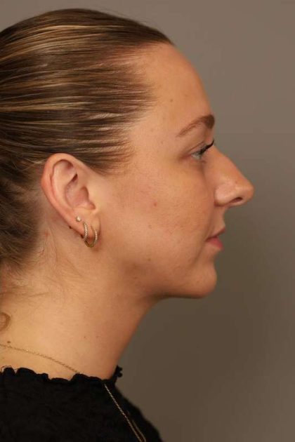 Chin Implant Before & After Patient #2262