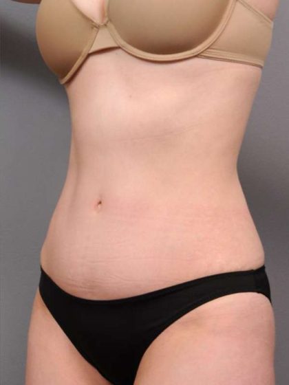 Tummy Tuck Before & After Patient #436