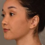 Facial Contouring Before & After Patient #2284