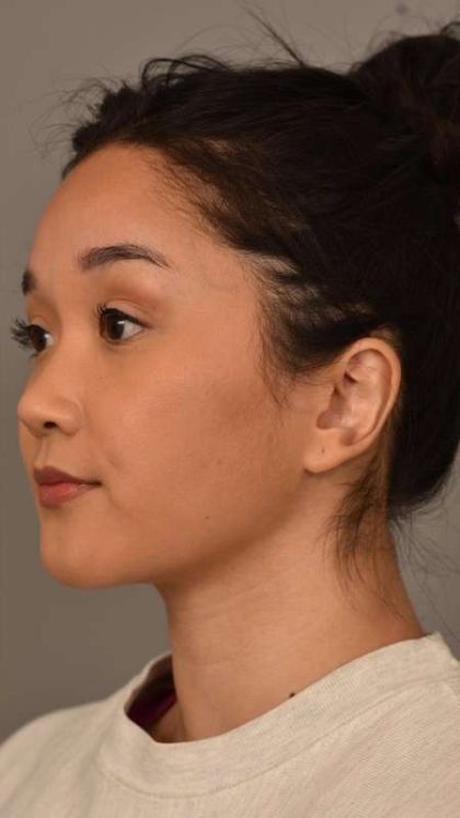 Facial Contouring Before & After Patient #2284