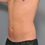 Liposuction For Men Before & After Patient #2294