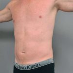 Liposuction For Men Before & After Patient #2301