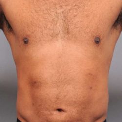 Liposuction For Men Before & After Patient #2315