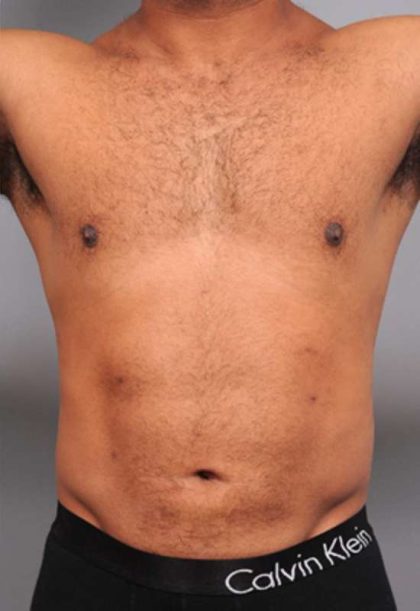 Liposuction For Men Before & After Patient #2315
