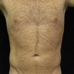 Liposuction For Men Before & After Patient #2347