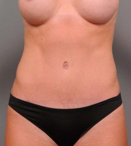 Tummy Tuck Before & After Patient #443