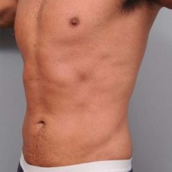 Liposuction For Men Before & After Patient #2386