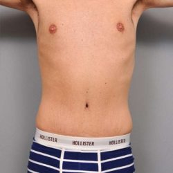 Tummy Tuck For Men Before & After Patient #2394