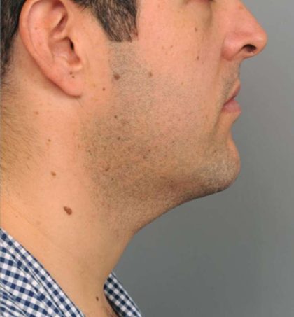 Neck Liposuction For Men Before & After Patient #2408