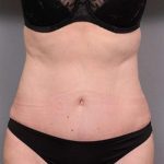 Tummy Tuck Before & After Patient #450