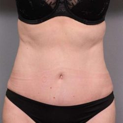 Tummy Tuck Before & After Patient #450