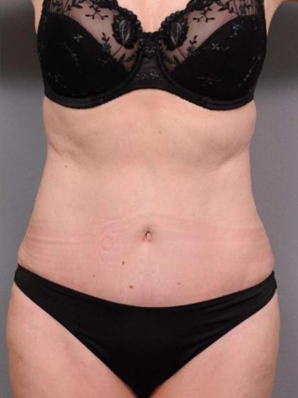 Tummy Tuck Before & After Patient #450
