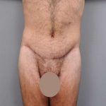 Lower Body Lift For Men Before & After Patient #2445