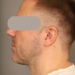 Neck Lift For Men Before & After Patient #2463