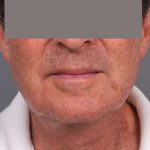 Neck Lift For Men Before & After Patient #2471