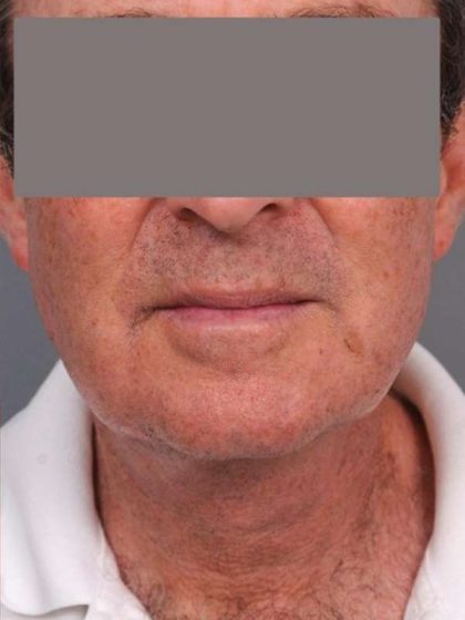 Neck Lift For Men Before & After Patient #2471