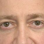 Eyelid Surgery For Men Before & After Patient #2476