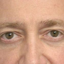 Eyelid Surgery For Men Before & After Patient #2476