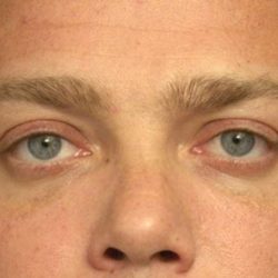 Eyelid Surgery For Men Before & After Patient #2481