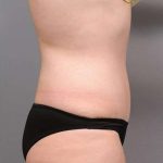 Tummy Tuck Before & After Patient #463